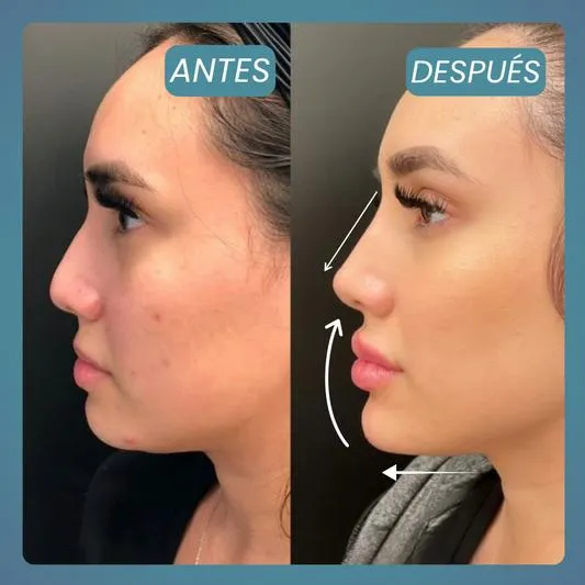 Biomodelación Facial