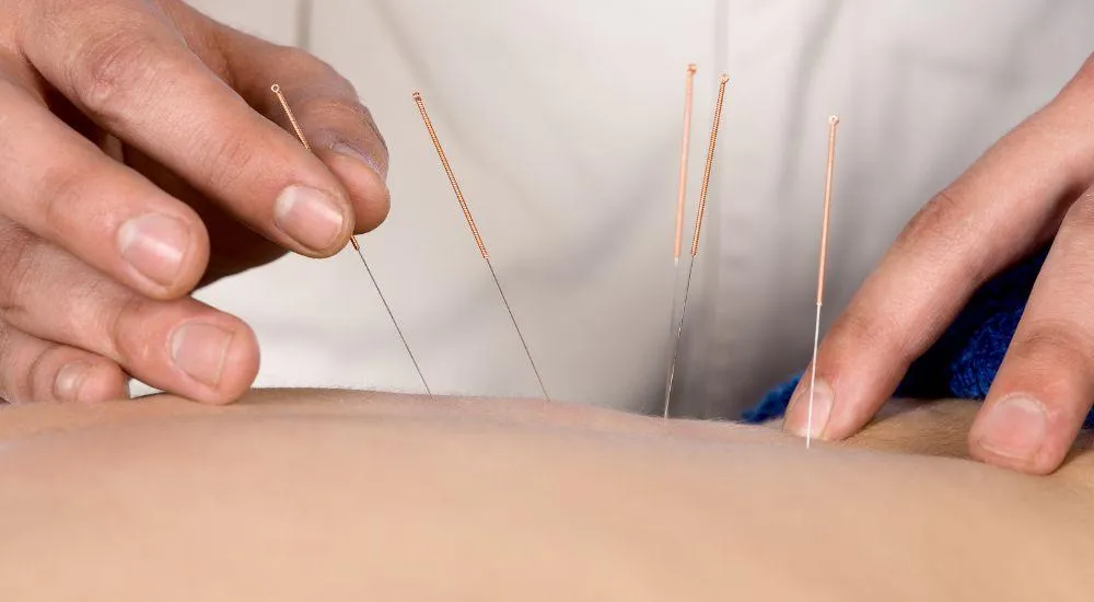 Acupuntura